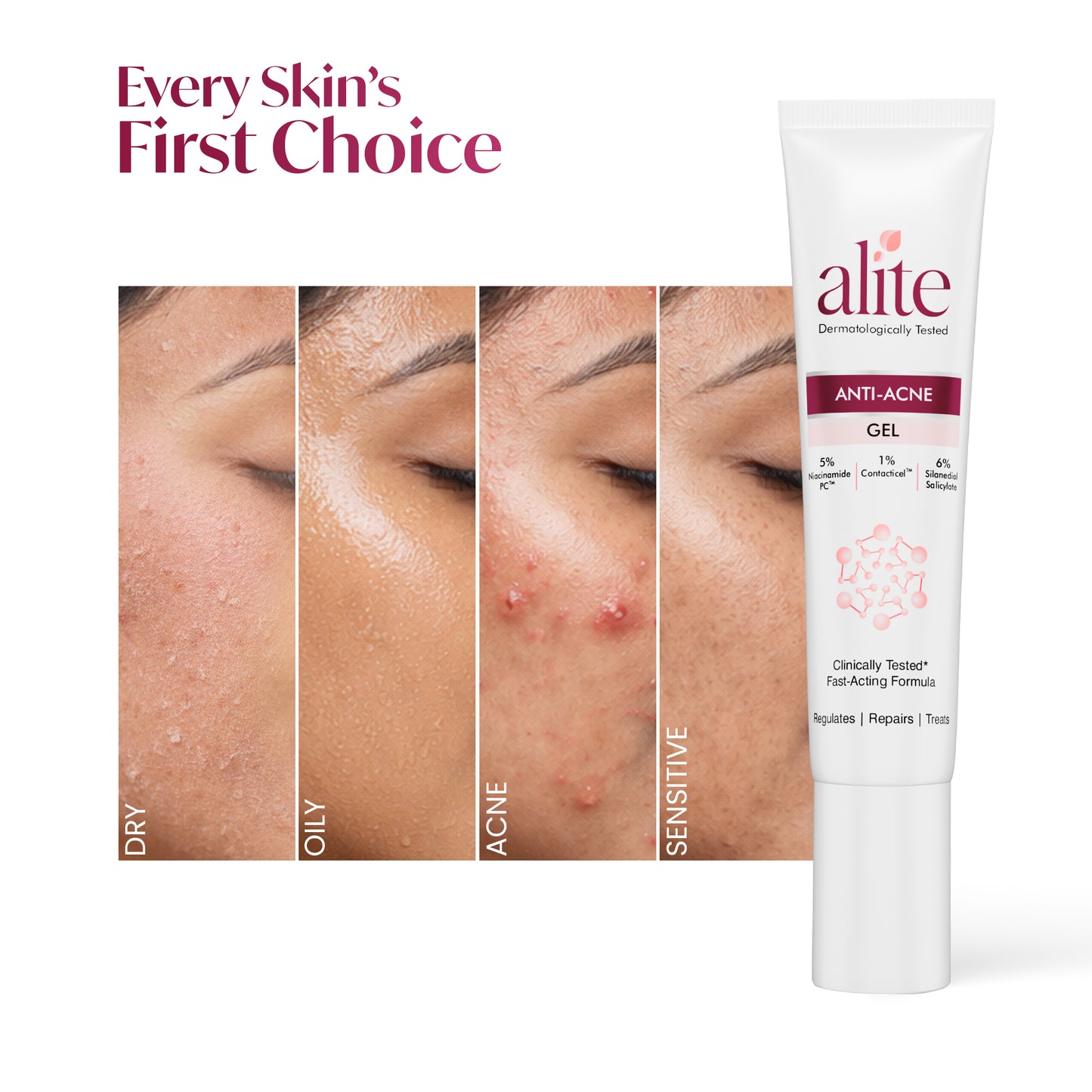 ALITE ANTI ACNE GEL