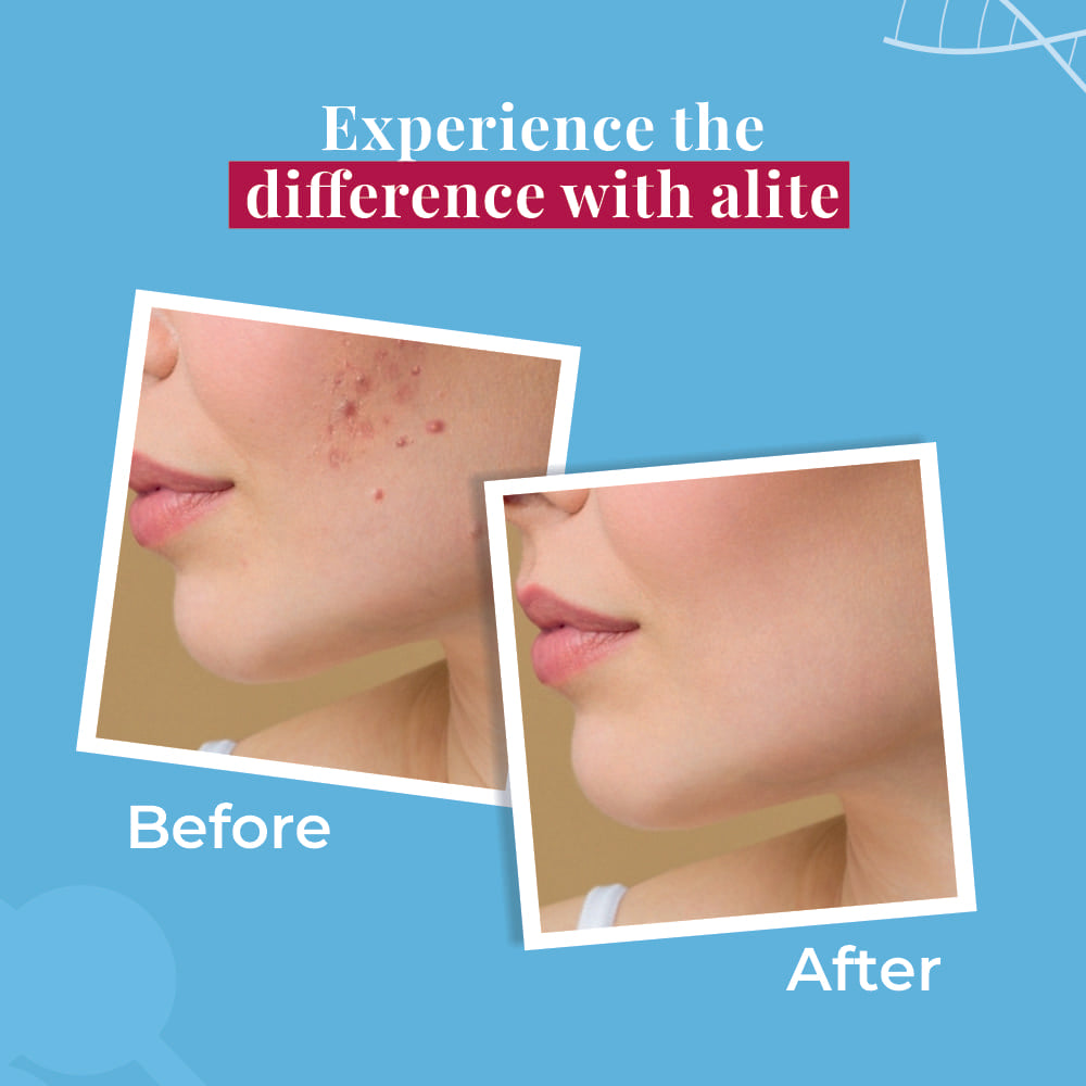 alite-spot-reduction-cream-15-g